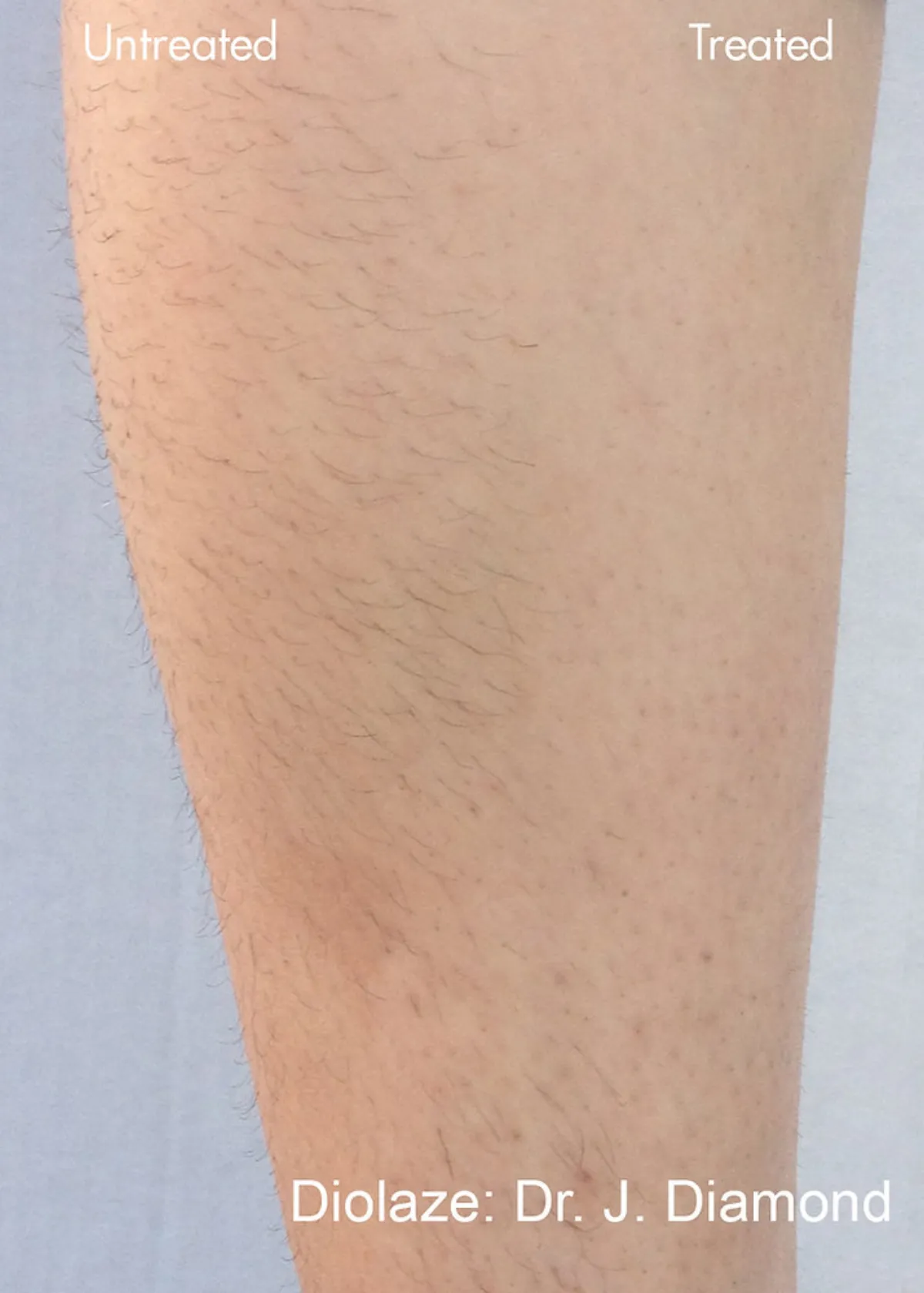 How Laser Hair Removal Works – Before, During & After