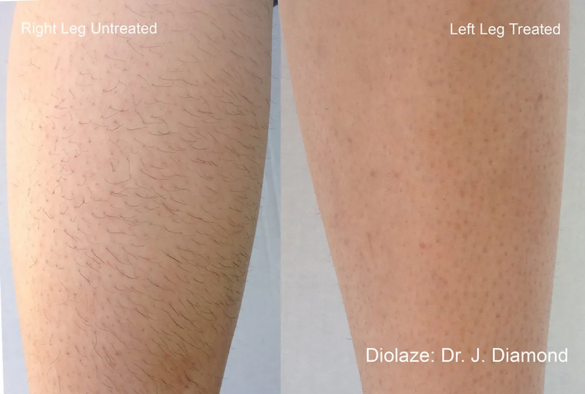 Laser Hair Removal in Eagle Mountain, Utah – What Areas Should I Do?