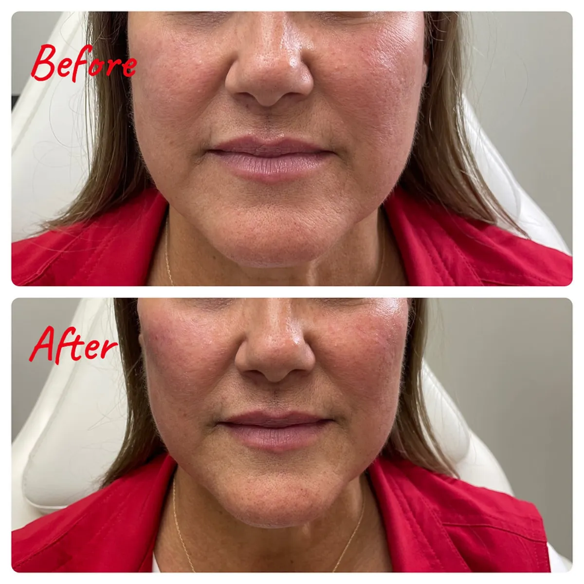 Is Lip Filler Right for You in Eagle Mountain, Utah?