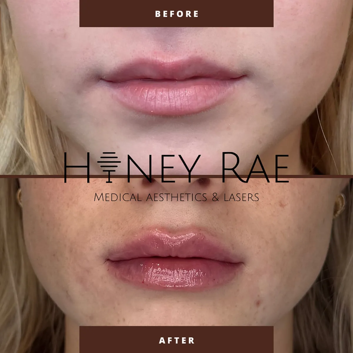 Lip Plump in Eagle Mountain, Utah – What You Need to Know