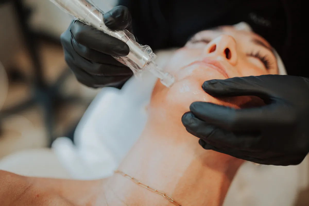 Microneedling in Eagle Mountain, Utah – What You Need to Know