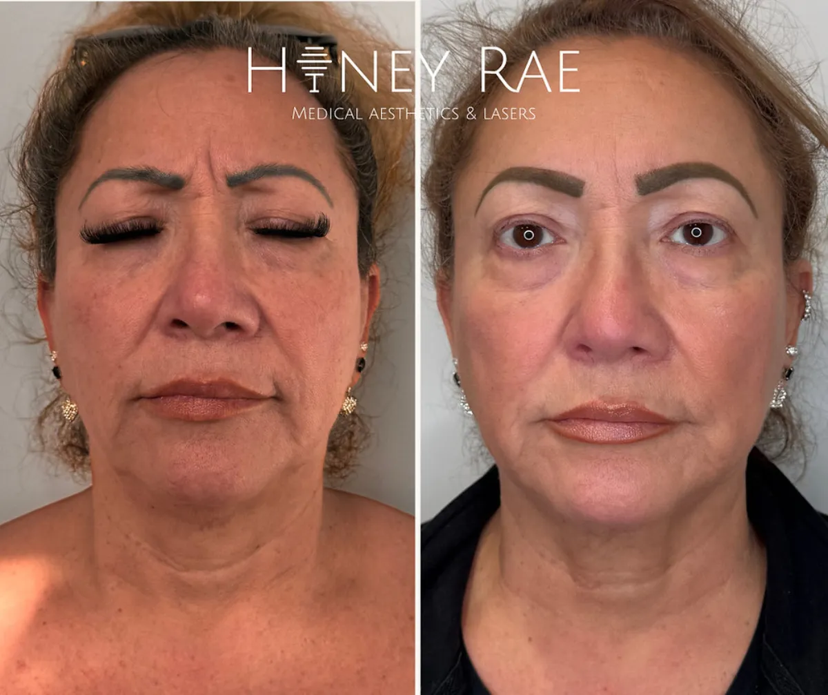 Microneedling vs Morpheus8 Eagle Mountain – Which Is Best?