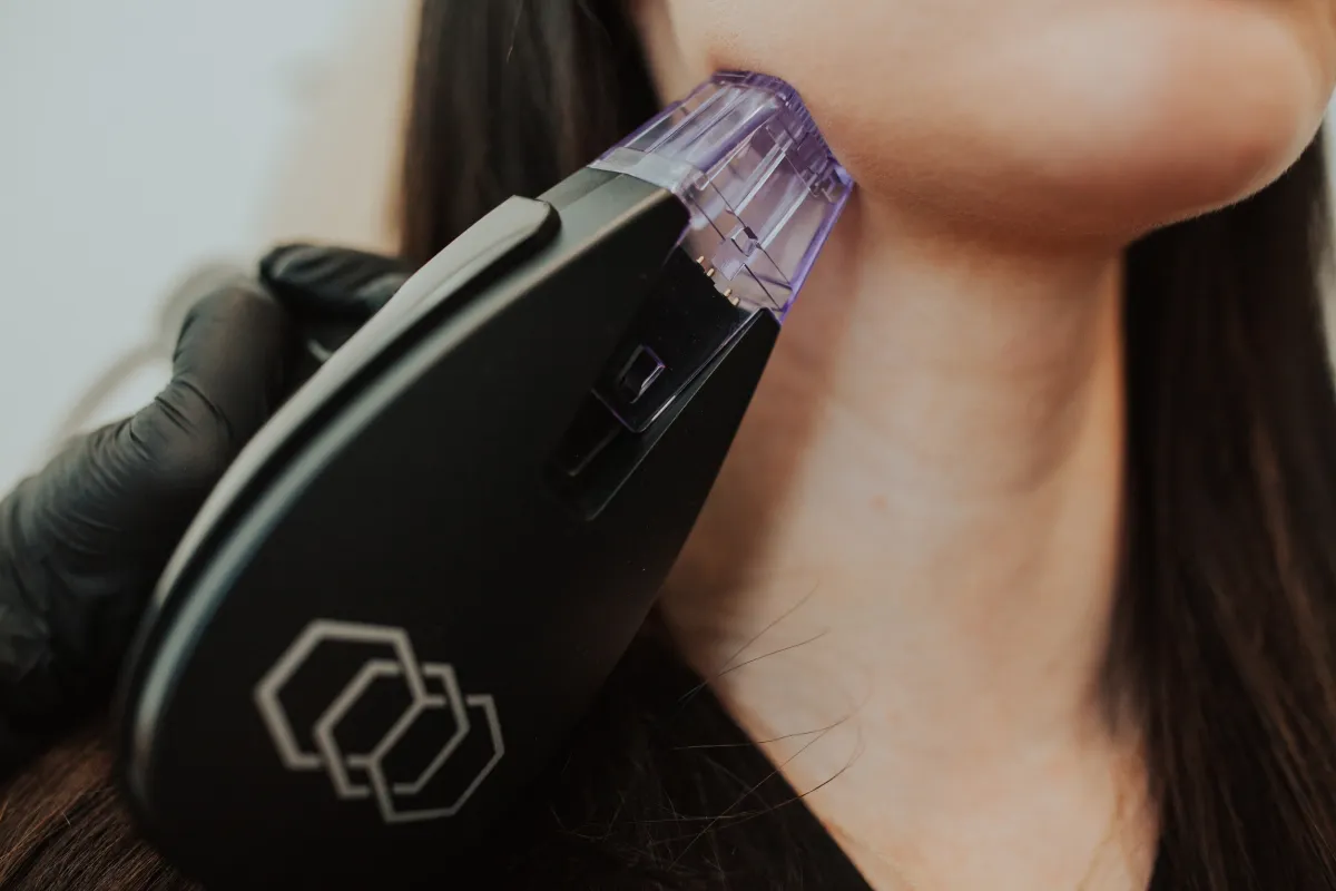 Morpheus8 in Eagle Mountain, Utah – Skin Tightening & Rejuvenation