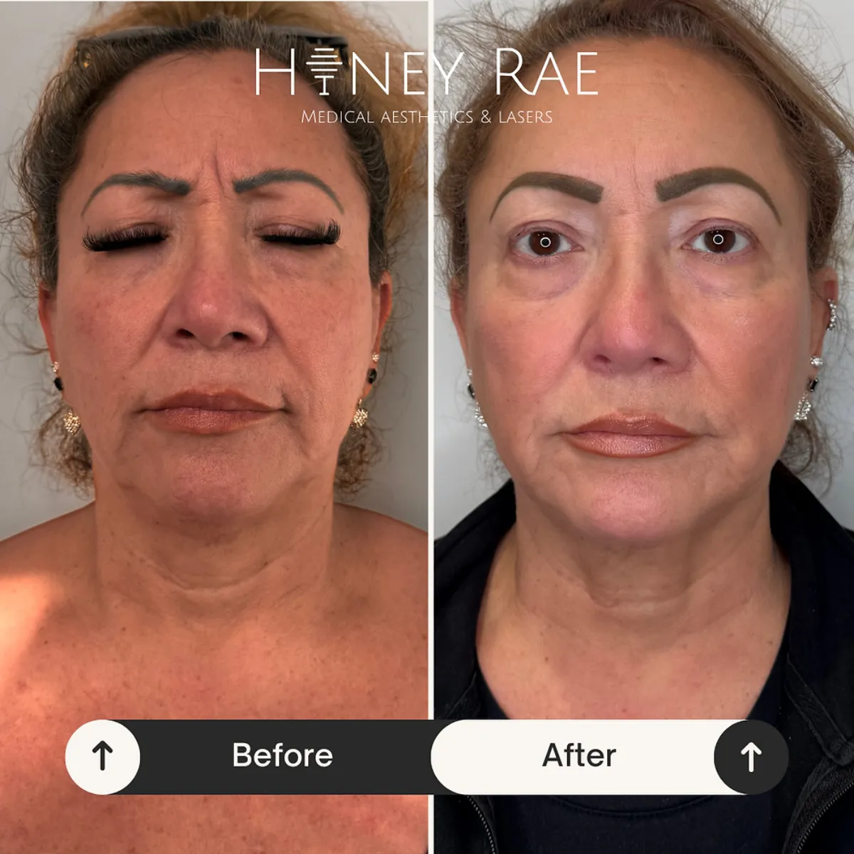 Morpheus8 in Eagle Mountain – What You Need to Know